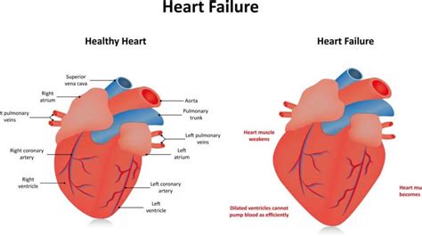 hypokinesia of lv